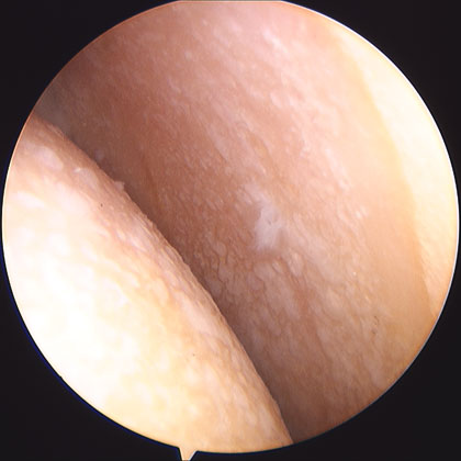 shoulder arthritis picture