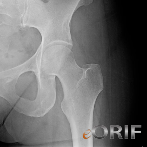 hip normal xray