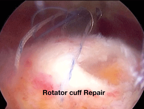 Rotator cuff repair Rotator cuff repair