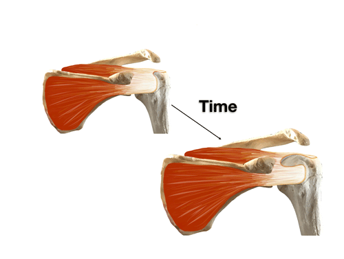 Rotator cuff tear time Rotator cuff tear time
