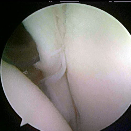 shoulder joint picture