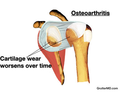Shoulder arthritis advanced
