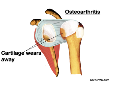 Shoulder arthritis Shoulder early arthritis