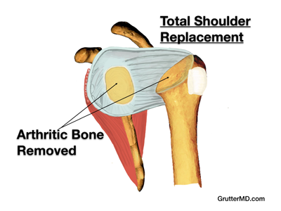 Shoulder replacement step 1 Shoulder replacement step 1