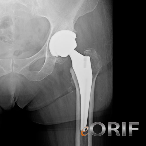 anterior hip xray
