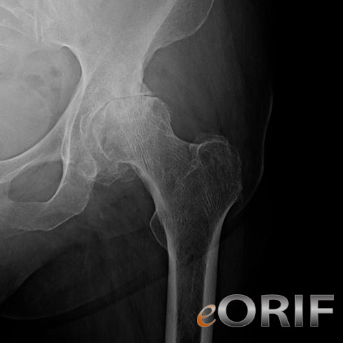 hip arthritis xray