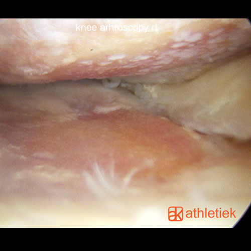 Knee arthritis arthroscopy 