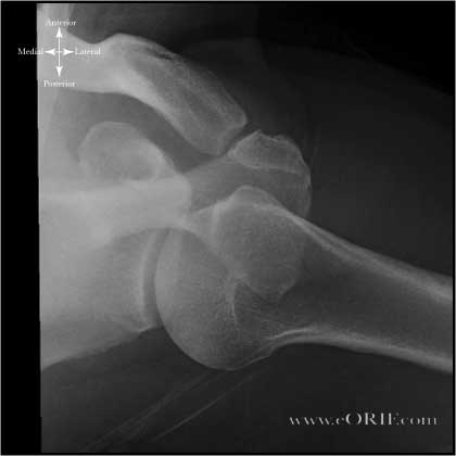 shoulder axillary xray