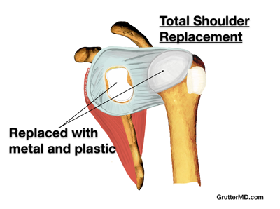 Shoulder replacement step 2 Shoulder replacement step 2