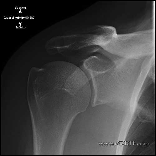 shoulder xray